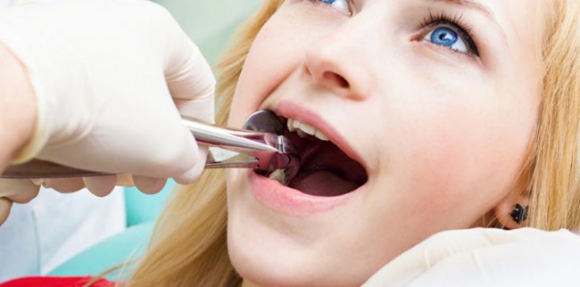 Брекеты и удаление зубов: когда «жертва» необходима?
